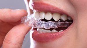 The Growing Demand For Clear Aligners In Modern Orthodontic Care